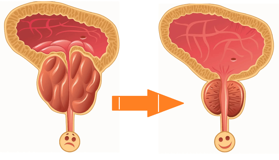 Uromexil Forte Akce na prostatu s prostatitidou a adenomem