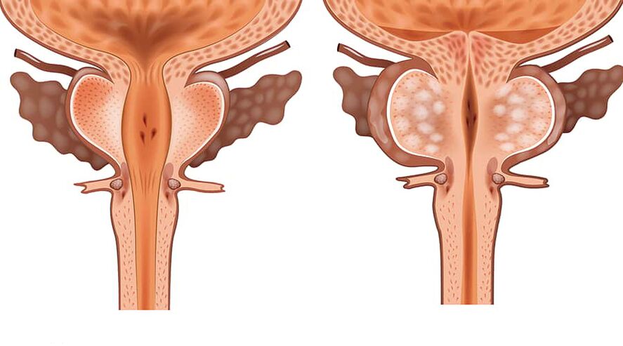 srovnání zdravého a zaníceného adenomu