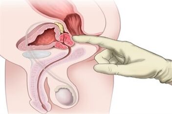Masáž prostaty pro léčbu chronické prostatitidy