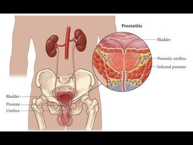 Prostatitida – zánět prostaty
