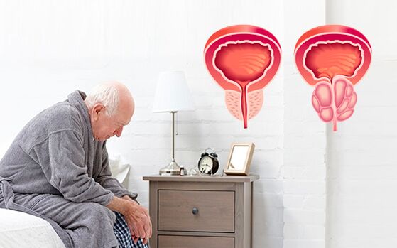 prostatitida u muže